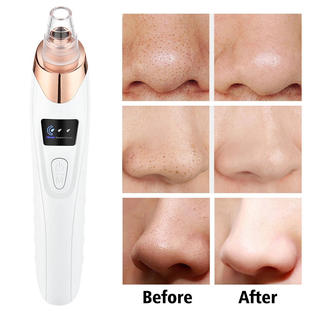 Removedor de Puntos Negros Limpiador Profundo Facial para Nariz y Zona T, Extractor de Acné y Espinillas por Succión al Vacío, Herramienta de Belleza Facial con Diamante para una Piel Limpia