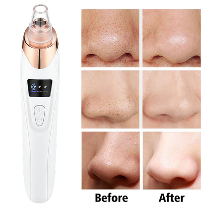 Removedor de Puntos Negros Limpiador Profundo Facial para Nariz y Zona T, Extractor de Acné y Espinillas por Succión al Vacío, Herramienta de Belleza Facial con Diamante para una Piel Limpia